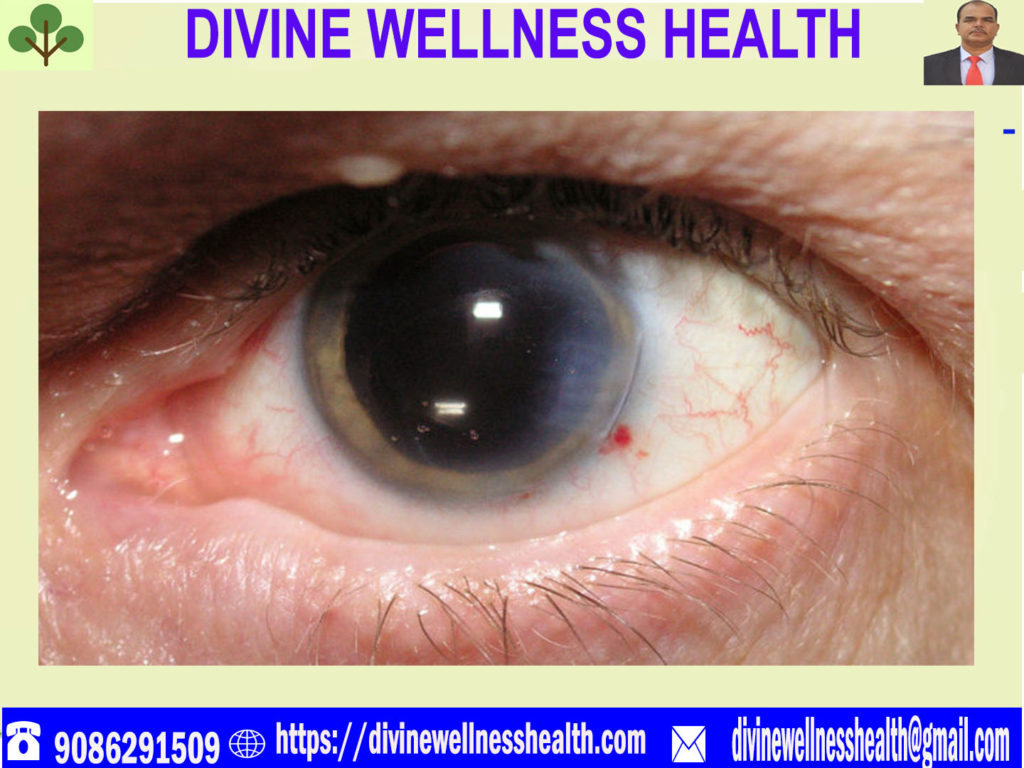 cataract | divinewellnesshealth